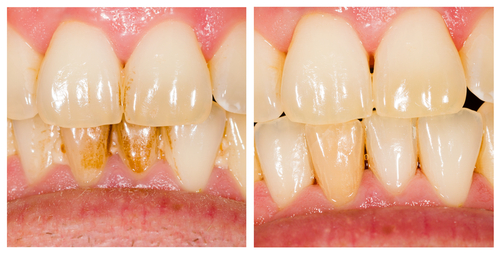 Periodontal Care